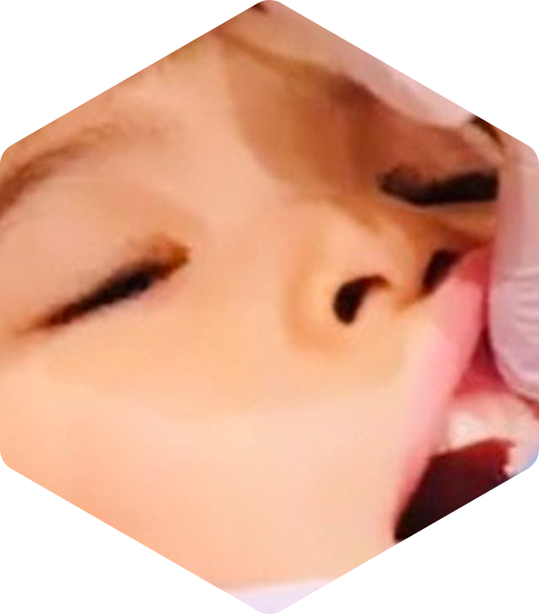 予防